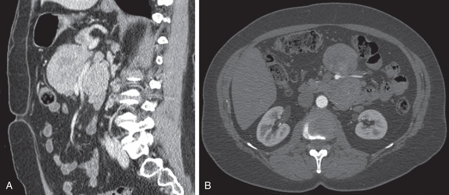 FIGURE 80.1, (A) Sagittal view from a computed tomography (CT) angiogram in a patient with a large neuroendocrine tumor of the proximal jejunum. The superior mesenteric artery can be seen to be enveloped by this bilobed tumor. (B) Axial view from the same CT angiogram showing the intimate anatomic relationship between the mesenteric vasculature and the neuroendocrine tumor of the proximal jejunum.