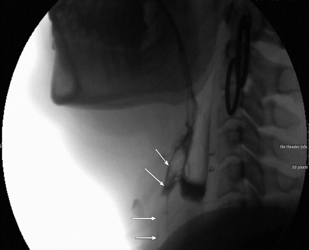 Fig. 4.2, Modified barium swallow with aspiration: on the lateral image, arrows show abnormal spillover with aspiration.