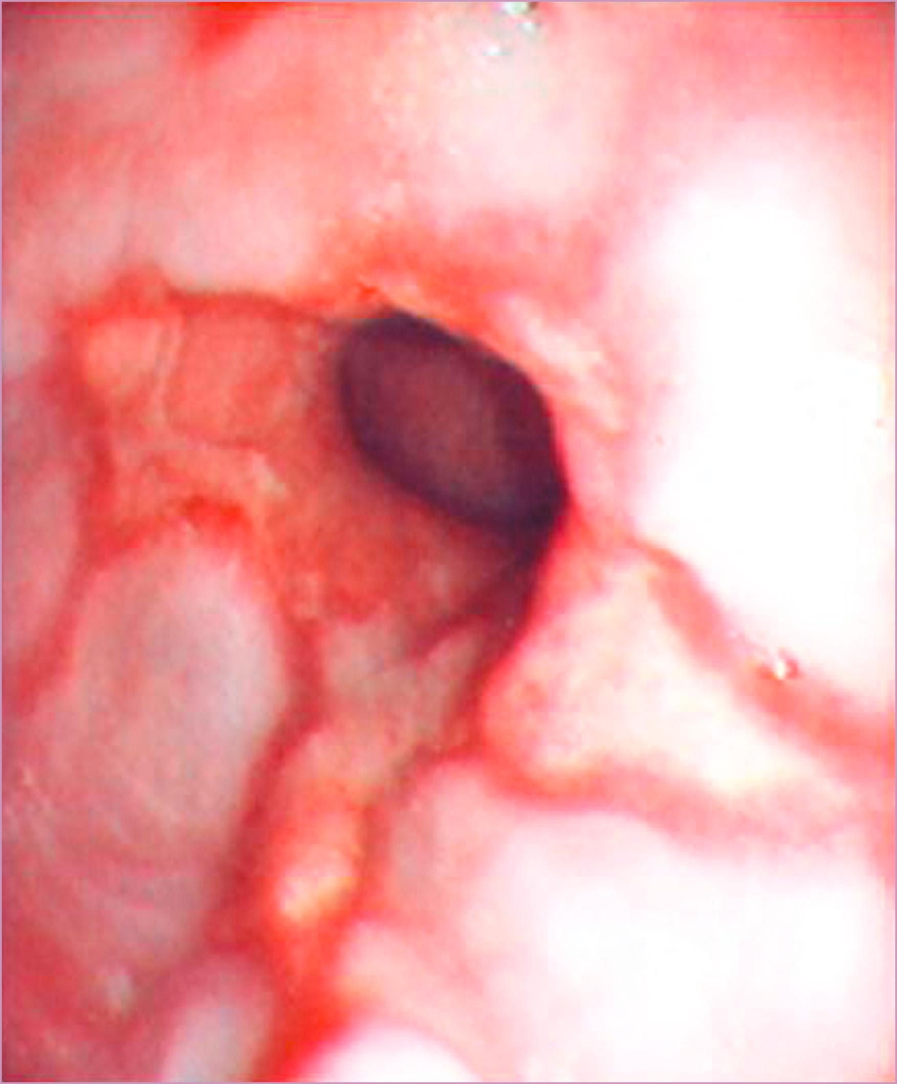 Figure 63.1, Endoscopic image of severe erosive esophagitis.