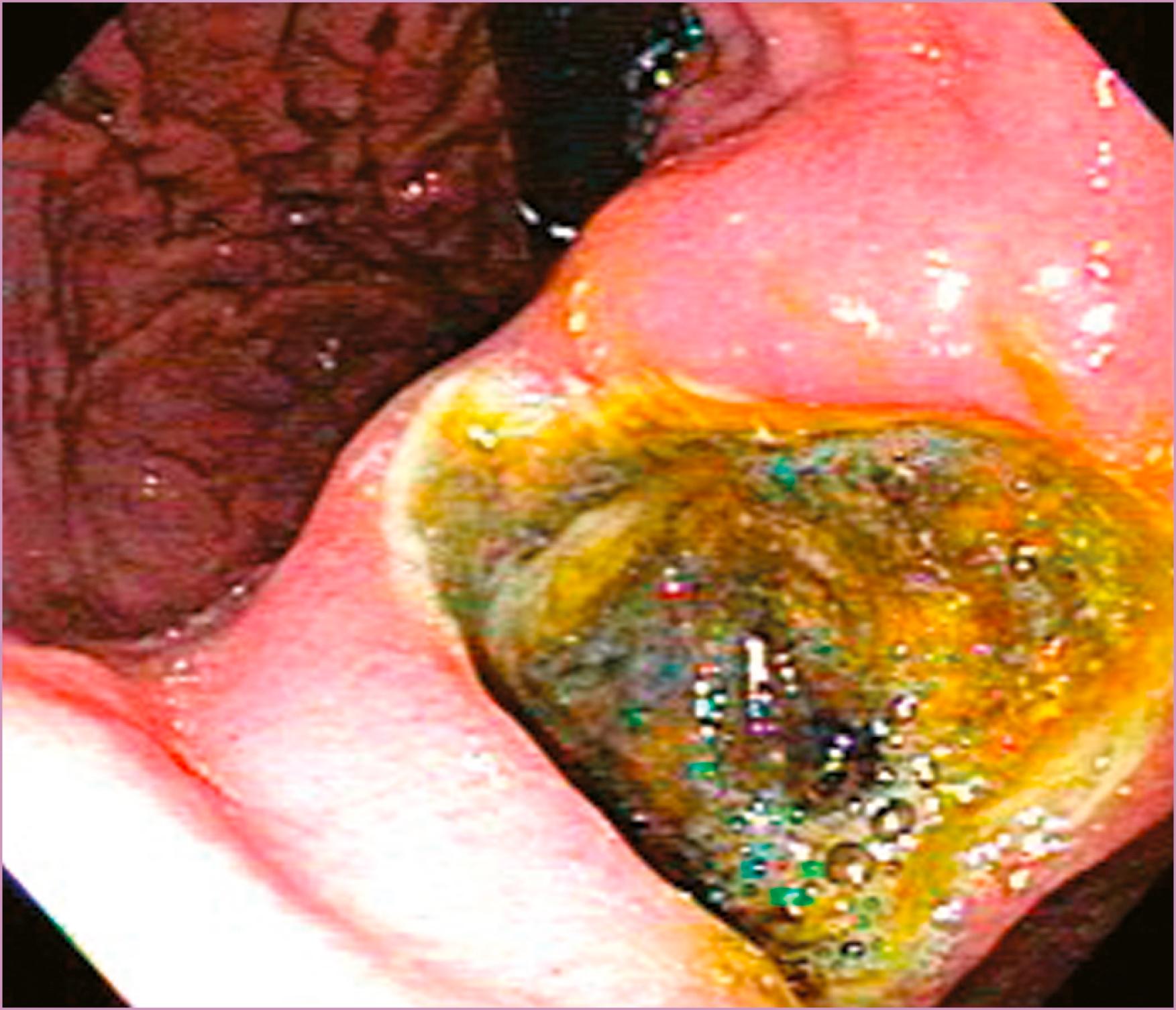 Figure 63.3, Endoscopic image of a deep gastric ulcer.