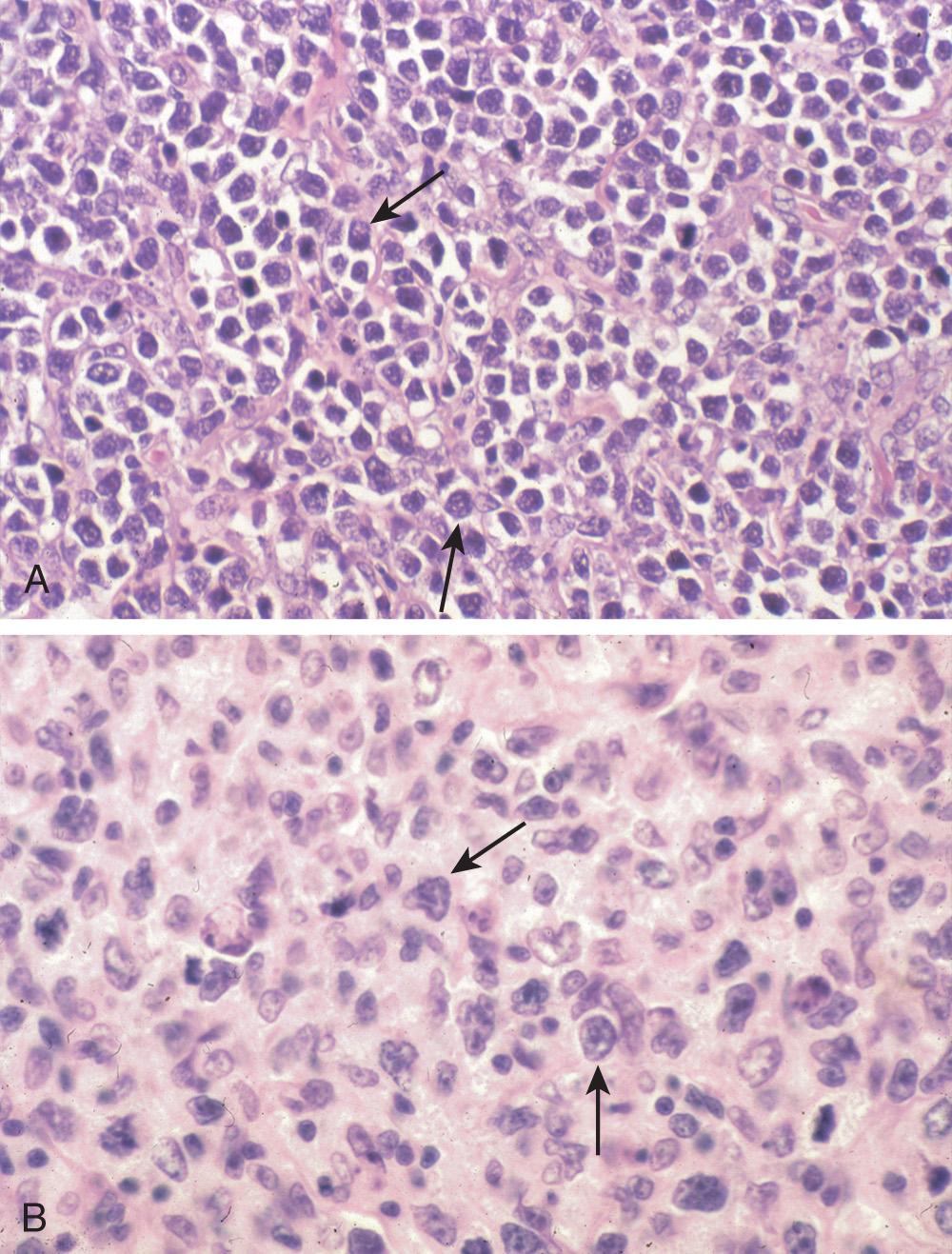 FIGURE 82.1, Diffuse large B-cell lymphoma of the stomach showing a monotonous high-grade infiltrate of large centroblast-like cells (arrows) under low- (A) and high-power (B) magnification.