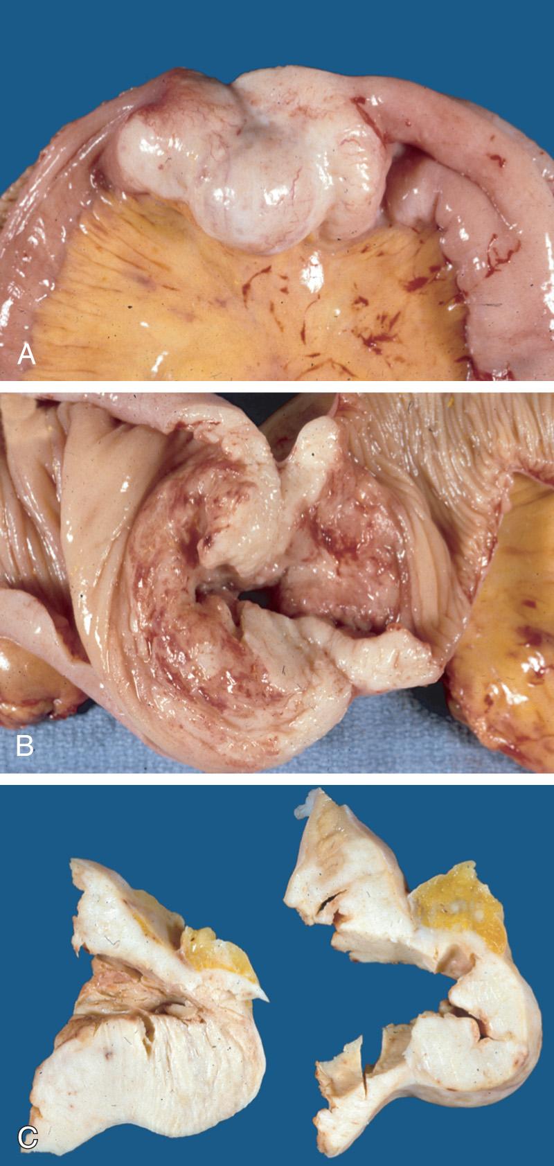 FIGURE 82.2, Diffuse large B-cell lymphoma of the jejunum, demonstrating the external aspect (A), the mucosal aspect (B), and cross sections showing transmural involvment and expansion of the wall by lymphoma (C).