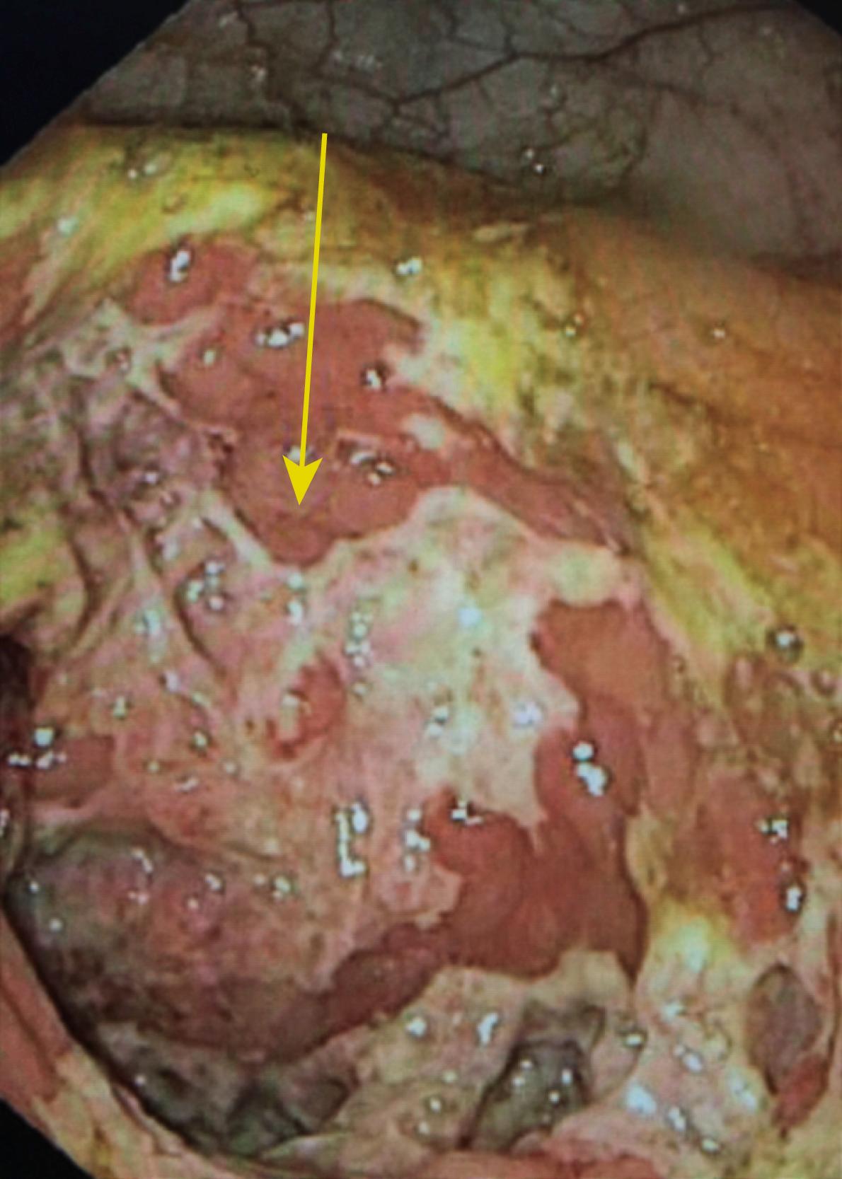 Fig. 40.6, Endoscopy identified an ulcerated cecum in a 12-year-old male with X-linked agammaglobulinemia who presented with diarrhea, abdominal pain, and weight loss. The patient was diagnosed with Crohn disease of his ileum and cecum, responded to infliximab therapy, and remains in remission after 4 years of treatment.