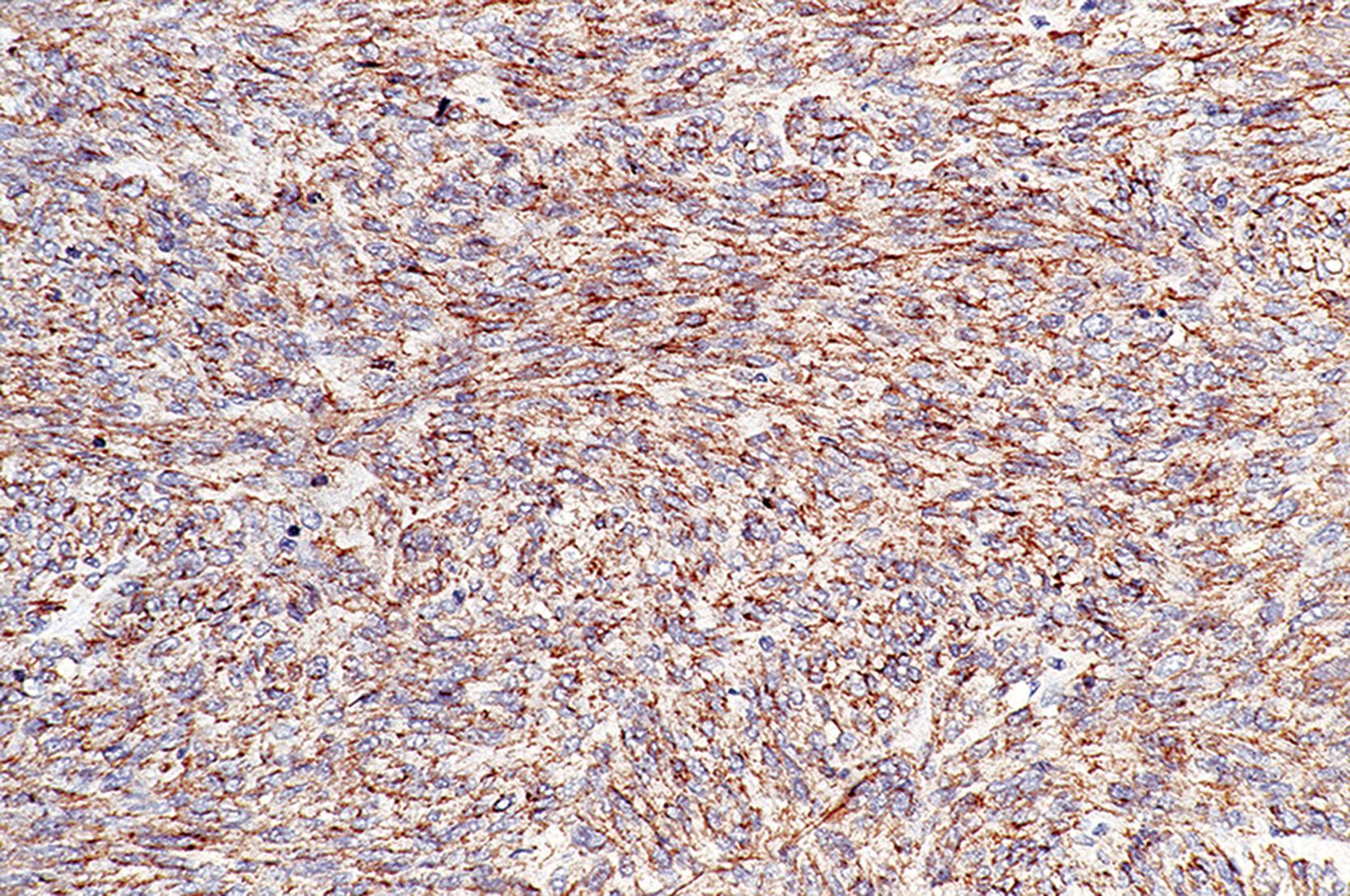 Figure 7.9, KIT staining in a KIT -mutant gastrointestinal stromal tumor (GIST). KIT shows diffuse membranous positivity in this tumor, and in general, it is positive in 95% of GISTs. KIT most commonly stains with a cytoplasmic pattern, although it can exhibit membranous (as shown here) and dot-like perinuclear staining.