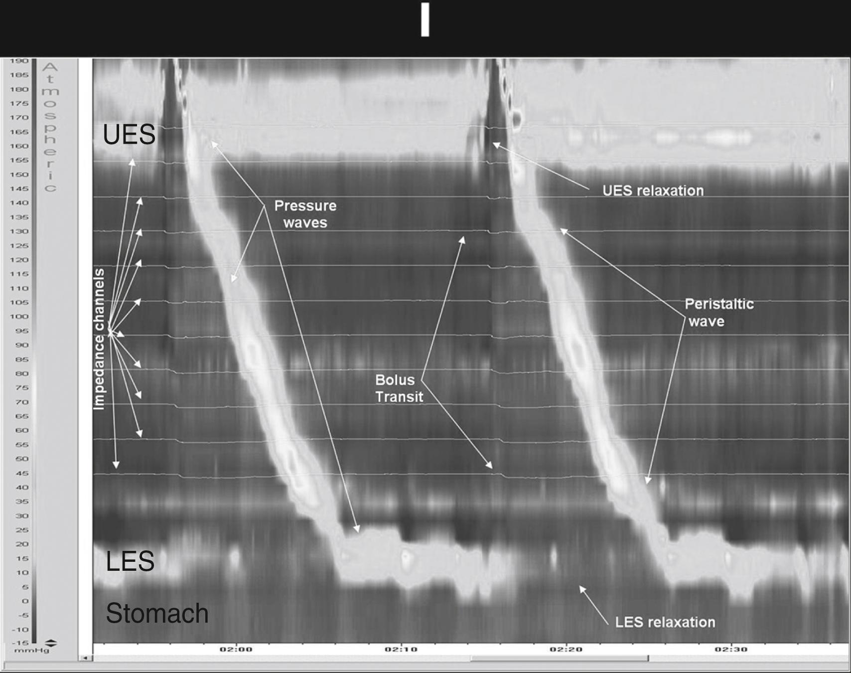 Fig. 64.1, Normal High-Resolution Esophageal Manometry.