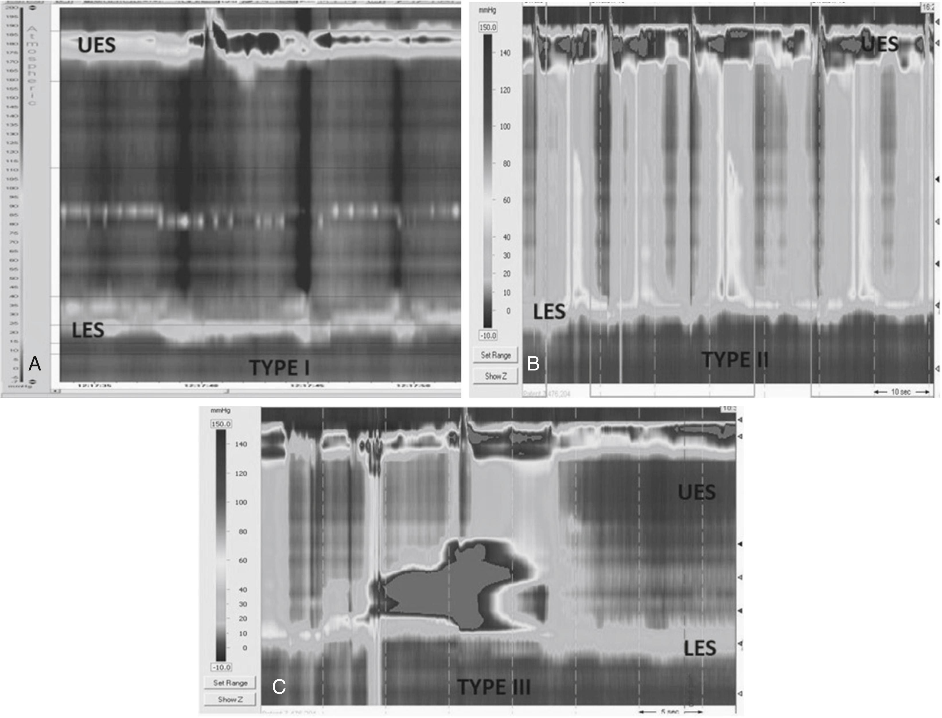 Fig. 64.2, Achalasia Subtypes.