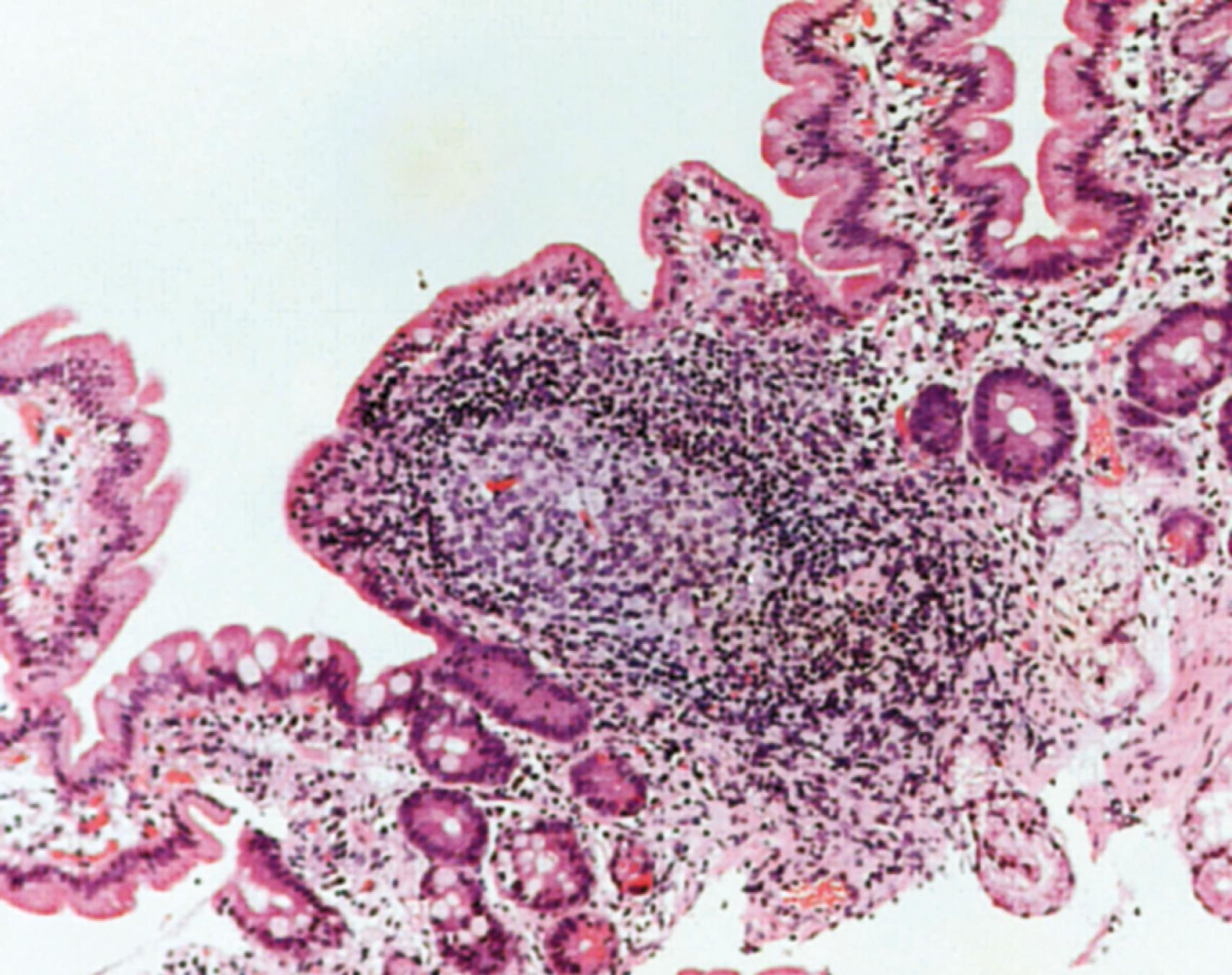 Fig. 5.3, An organized lymphoid follicle in the duodenum. Large numbers of dark staining intraepithelial lymphocytes may be seen in the epithelium overlying the follicle.