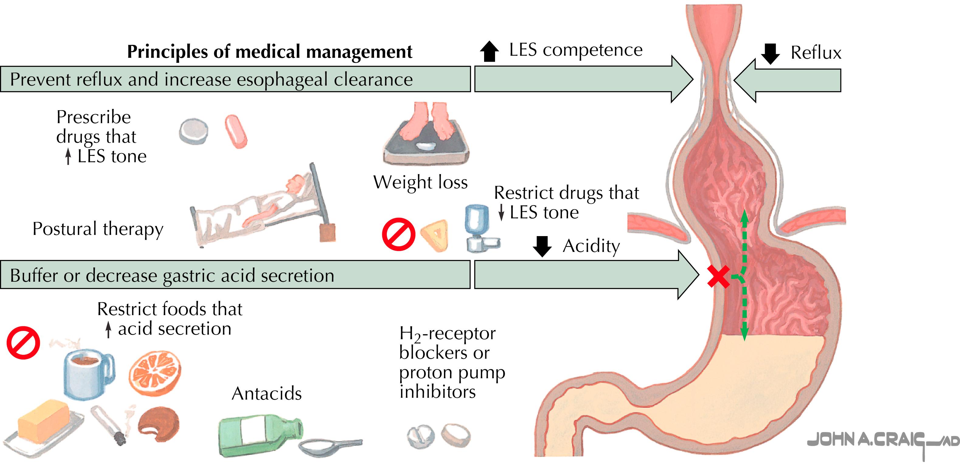 Figure 30.1, Gastroesophageal reflux.