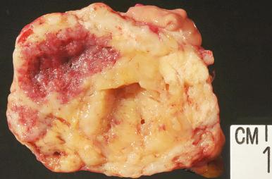 Fig. 17.2, Gastric GIST with typical fleshy appearance and central degeneration.