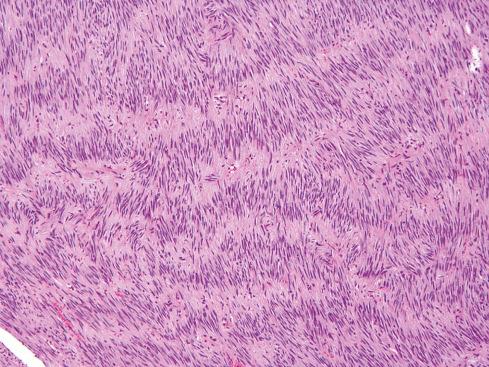 Fig. 17.12, Gastric spindle cell GIST with nuclear palisading mimicking a schwannoma.
