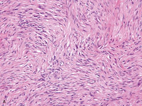 Fig. 17.16, Conventional spindle cell component ( A ) and dedifferentiated component with rhabdoid morphology ( B ) of dedifferentiated GIST. KIT immunohistochemical stain ( C ) shows abrupt loss of staining in dedifferentiated component ( upper right ).