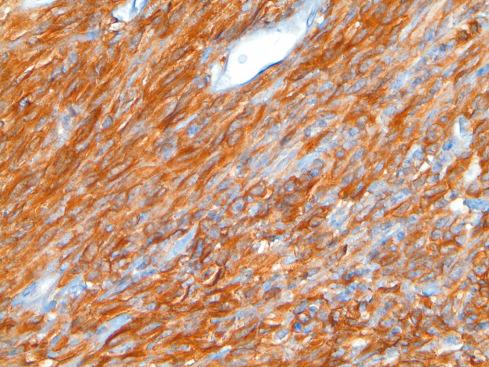 Fig. 17.17, Cytoplasmic KIT immunoreactivity.