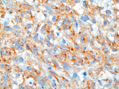 Fig. 17.19, Dotlike KIT immunoreactivity.