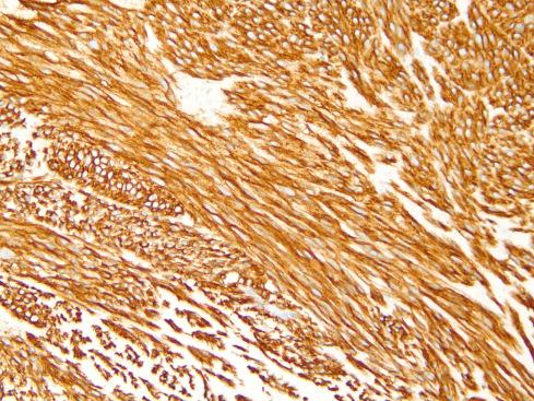 Fig. 17.20, DOG1 immunohistochemistry in spindle cell GIST.