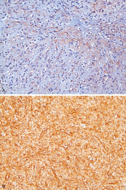 Fig. 17.21, KIT ( A ) and DOG1 ( B ) immunohistochemistry in KIT-negative GIST.