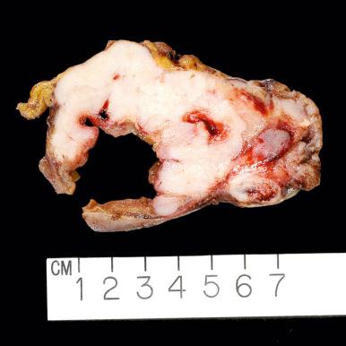 Fig. 17.3, Aggressive GIST infiltrating through wall of the small bowel.