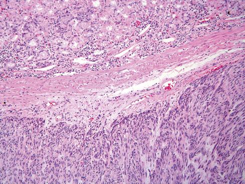 Fig. 17.4, Typical spindle cell GIST with smooth, noninfiltrative interface with muscularis mucosae.