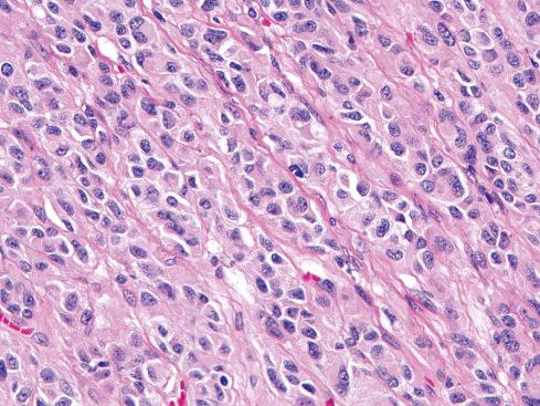 Fig. 17.5, Epithelioid GIST with nested growth pattern.