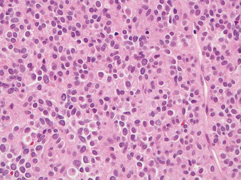 Fig. 17.6, Epithelioid GIST with diffuse growth pattern.