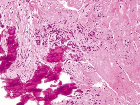 Fig. 17.10, Hyalinized microGIST with coarse calcifications.