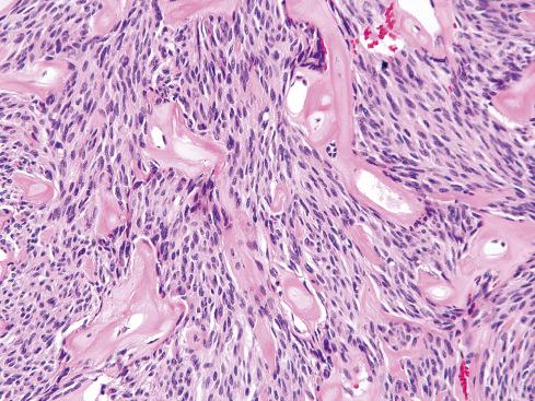 Fig. 17.11, Spindle cell GIST with prominent hyalinized blood vessels mimicking a schwannoma.