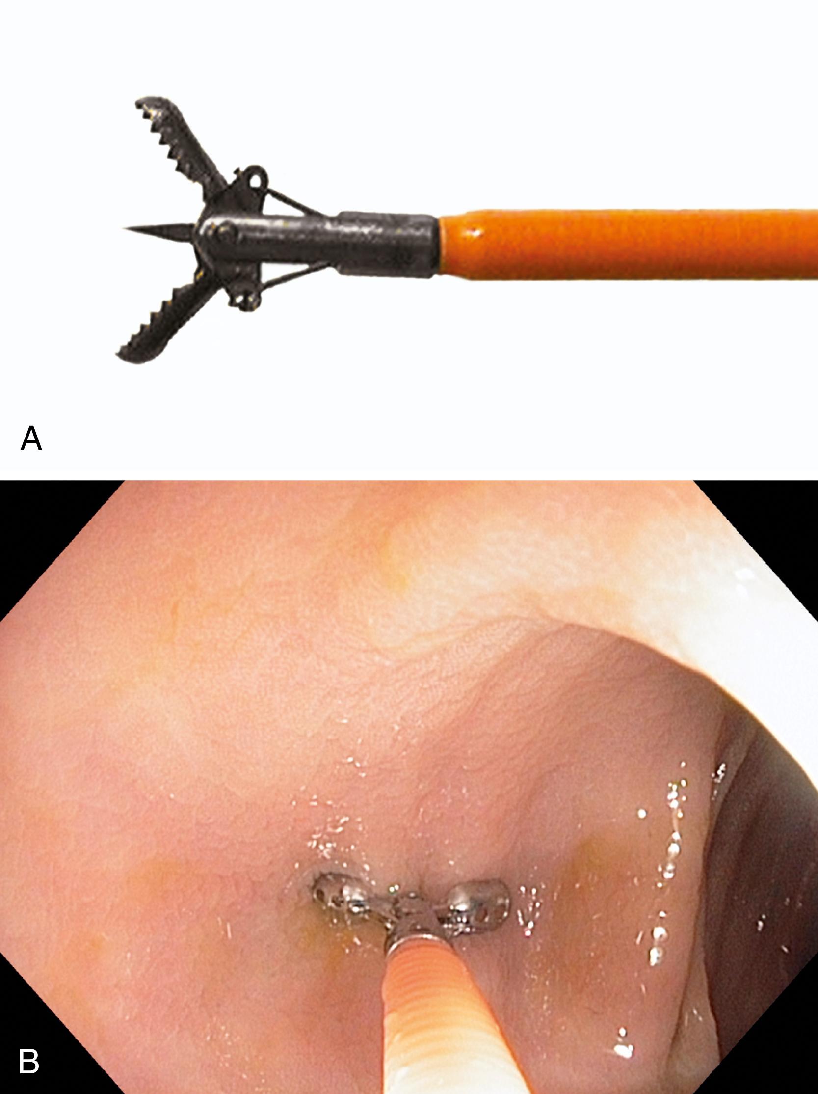 FIGURE 1.1, Endoscopic biopsy forceps.