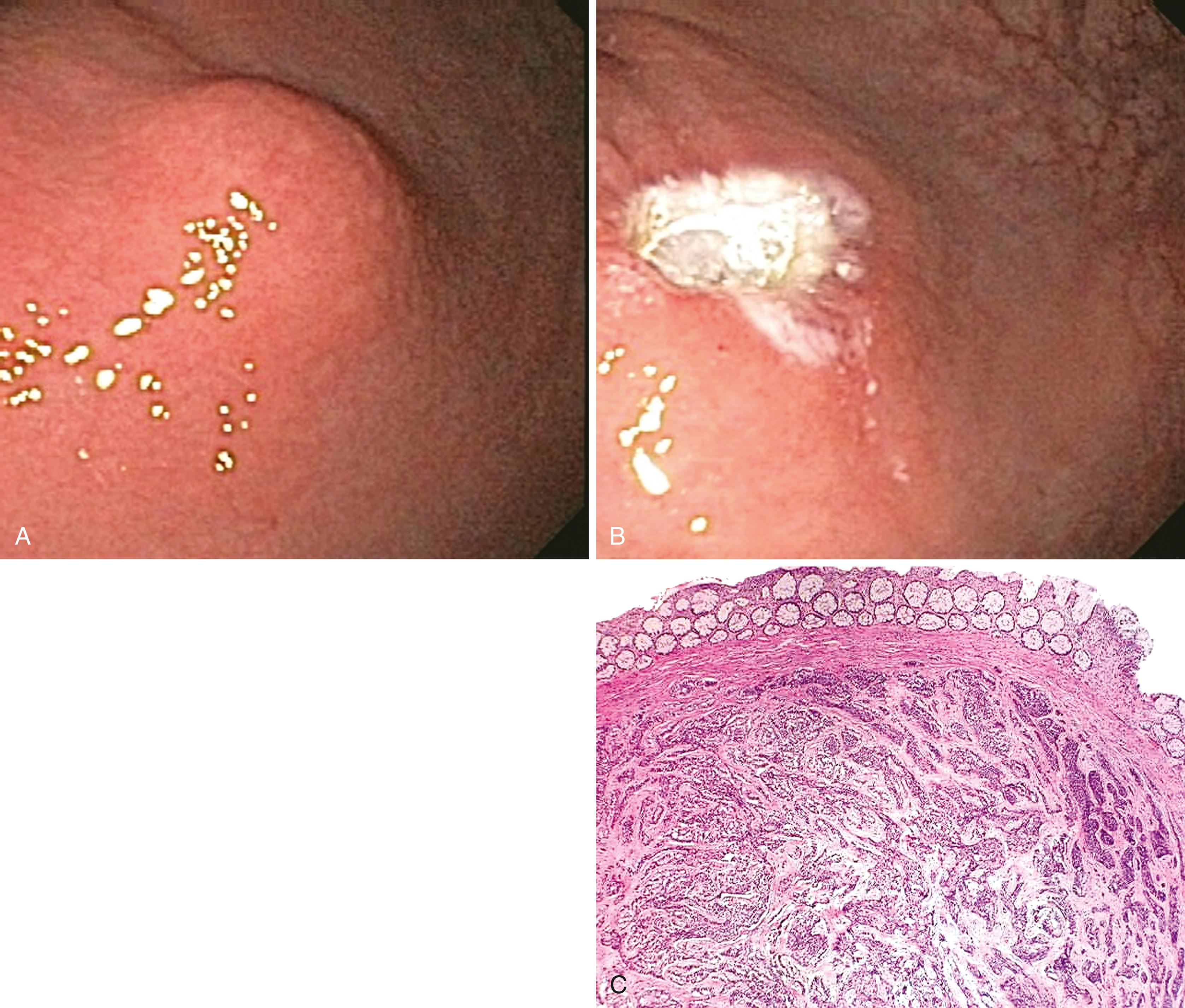 FIGURE 1.4, Resection of a submucosal well-differentiated neuroendocrine tumor (carcinoid) in the rectum.