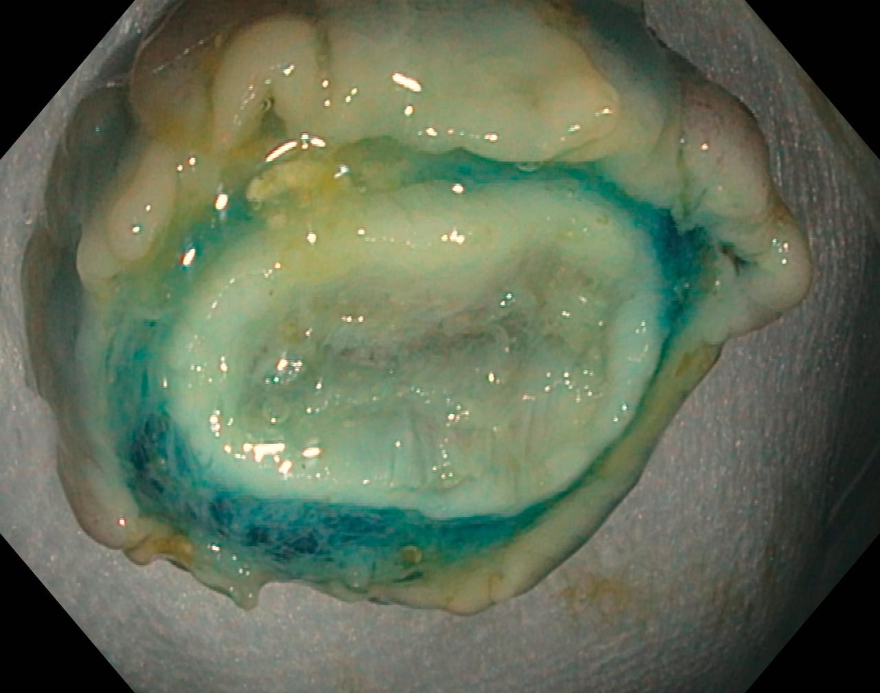 FIGURE 1.5, Ex vivo view of a resected polyp.The central white ring corresponds to the muscularis propria and indicates a perforation of the bowel wall. The blue layer represents submucosa that is stained by injection of methylene blue during endoscopic mucosal resection. When properly recognized, as was done here, the perforation can be closed immediately by endoscopic clipping.