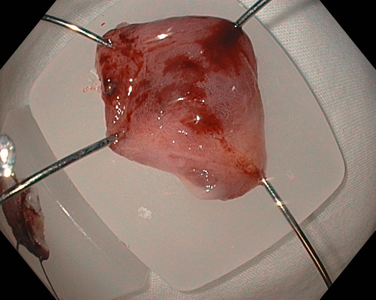 FIGURE 1.6, Barrett’s esophagus specimen removed by cap-band endoscopic mucosal resection and pinned to a paraffin block at the bedside with the mucosal side up to facilitate margin and depth assessment.