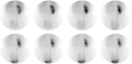 Figure 81-2, Nonvisualization of kidney on renal scintigraphy (posterior projection). Note lack of visualization of left kidney in this patient who is status post left nephrectomy for renal cell carcinoma. The right kidney appears slightly enlarged due to compensatory hypertrophy and has a normal cortical transit time.