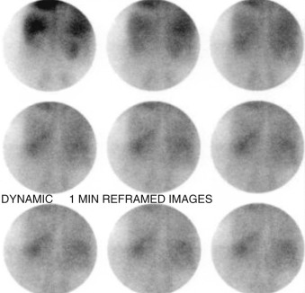 Figure 81-3, Nonvisualization of kidneys on renal scintigraphy (posterior projection). Delayed scintigraphic images in patient with chronic renal failure show bilaterally decreased radiotracer uptake in kidneys and no clear evidence of renal function. The kidneys have less radiotracer activity than the liver and spleen, rather than more radiotracer activity, confirming the overall poor renal flow and function.