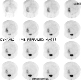 Figure 81-4, Normal appearing renal transplant on renal scintigraphy (anterior projection). Radiotracer uptake in renal transplant is good, and cortical transit is within 5 minutes, with good radiotracer excretion seen into bladder. This patient is status post living-related donor renal transplantation 1 day ago.