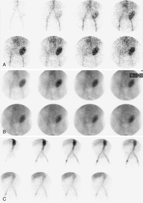 Figure 81-5, Renal transplant complications on renal scintigraphy (anterior projection). A, Note good renal transplant flow in patient 1 day status post cadaveric renal transplantation. B, Also note no clear evidence of renal function in same patient. This constellation of findings is consistent with ATN. Urinary tract obstruction or leak cannot be adequately assessed on this scan because of overall poor renal function. C, Note severely decreased flow and function to renal transplant in different patient consistent with chronic transplant rejection.