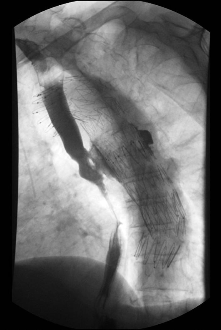 Fig. 2.2, Postoperative swallow study with water-soluble contrast demonstrates a posterior leak, which communicates with the aortic graft, consistent with aortoesophageal fistula.