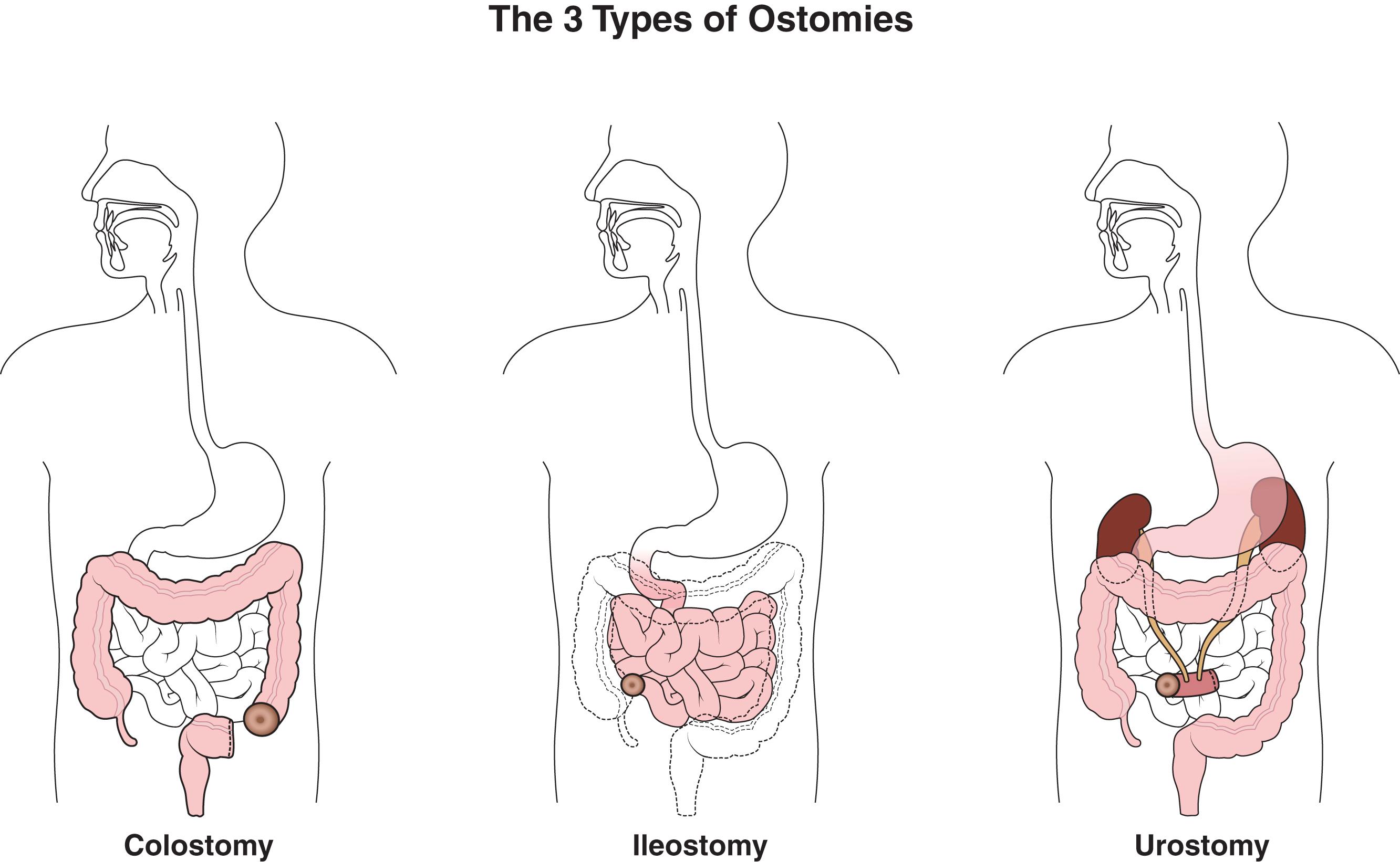 Figure 14.10, Types of stomas on abdominal examination.