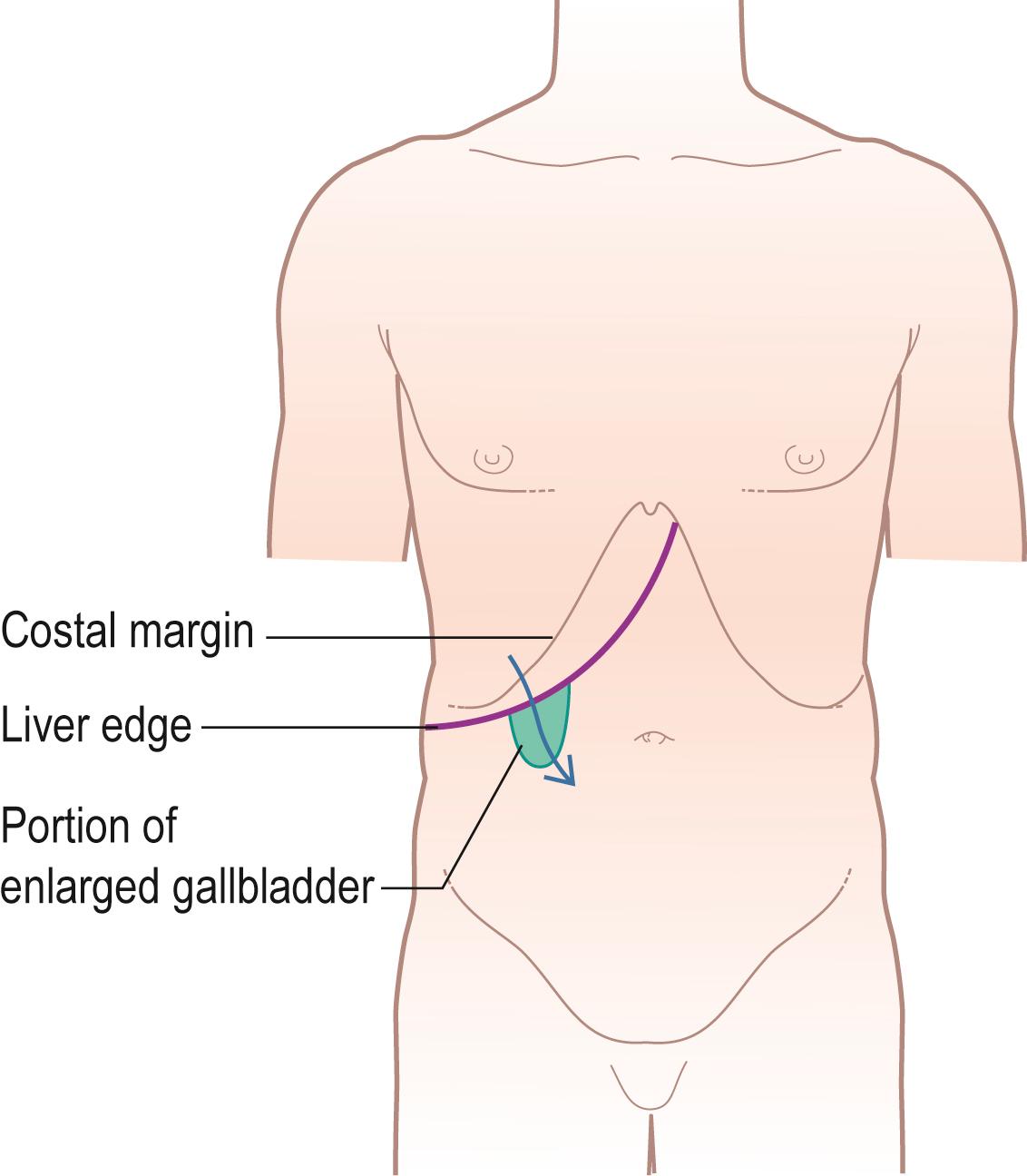 Figure 14.15, Palpation of an enlarged gallbladder, showing how it merges with the inferior border of the liver so that only the fundus of the gallbladder and part of its body can be palpated.