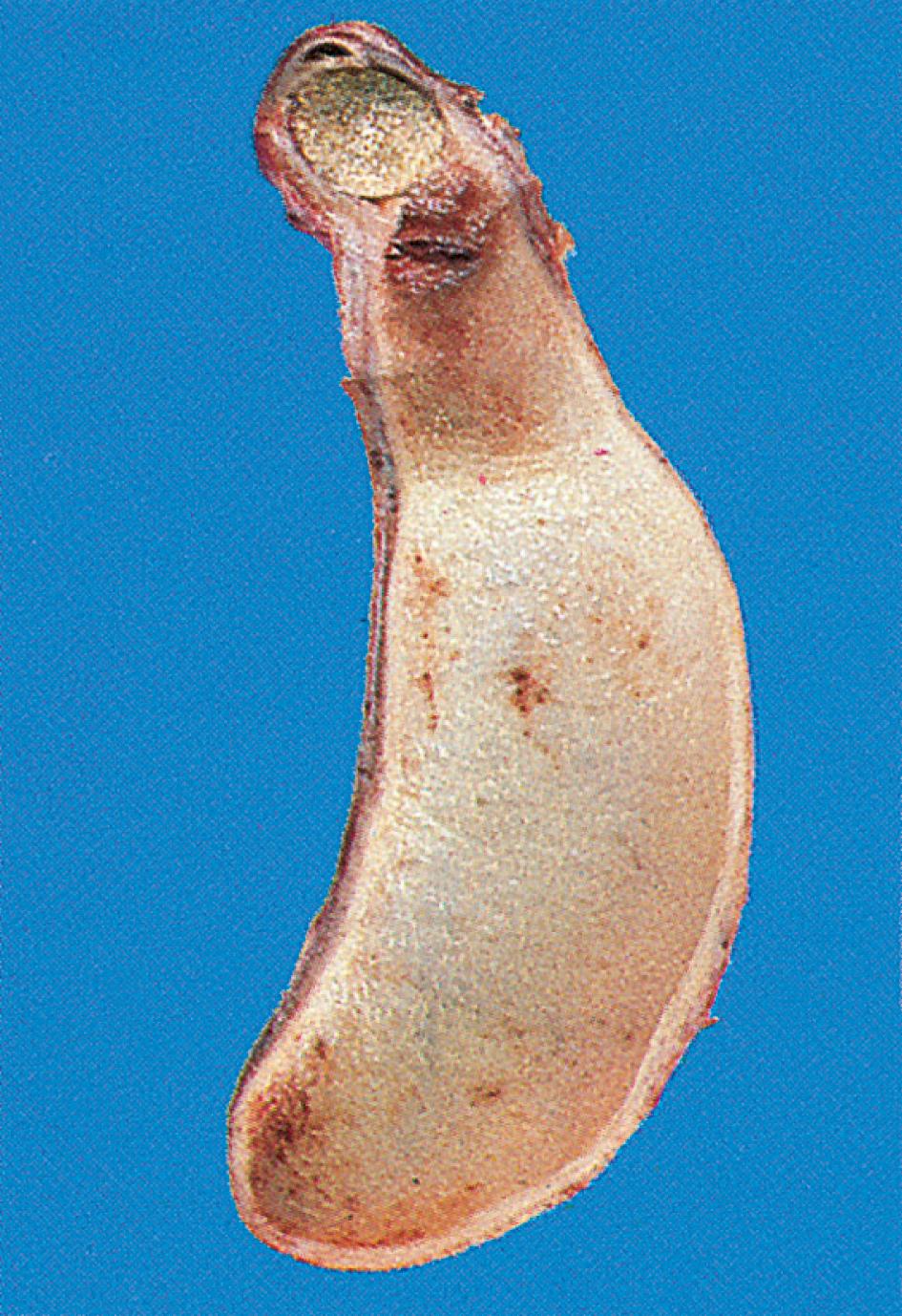 Figure 14.16, A mucocele of the gallbladder that is distended, pale and thin walled.