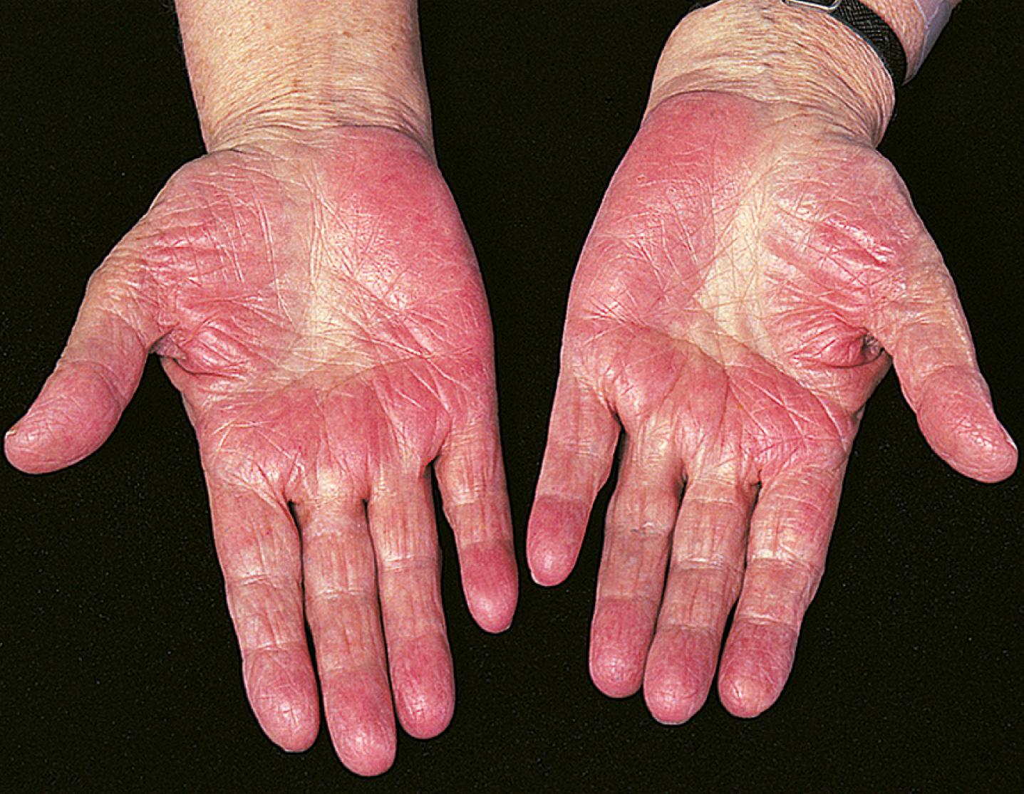 Figure 14.4, Palmar erythema in chronic liver disease (sparing the centre of the palms).