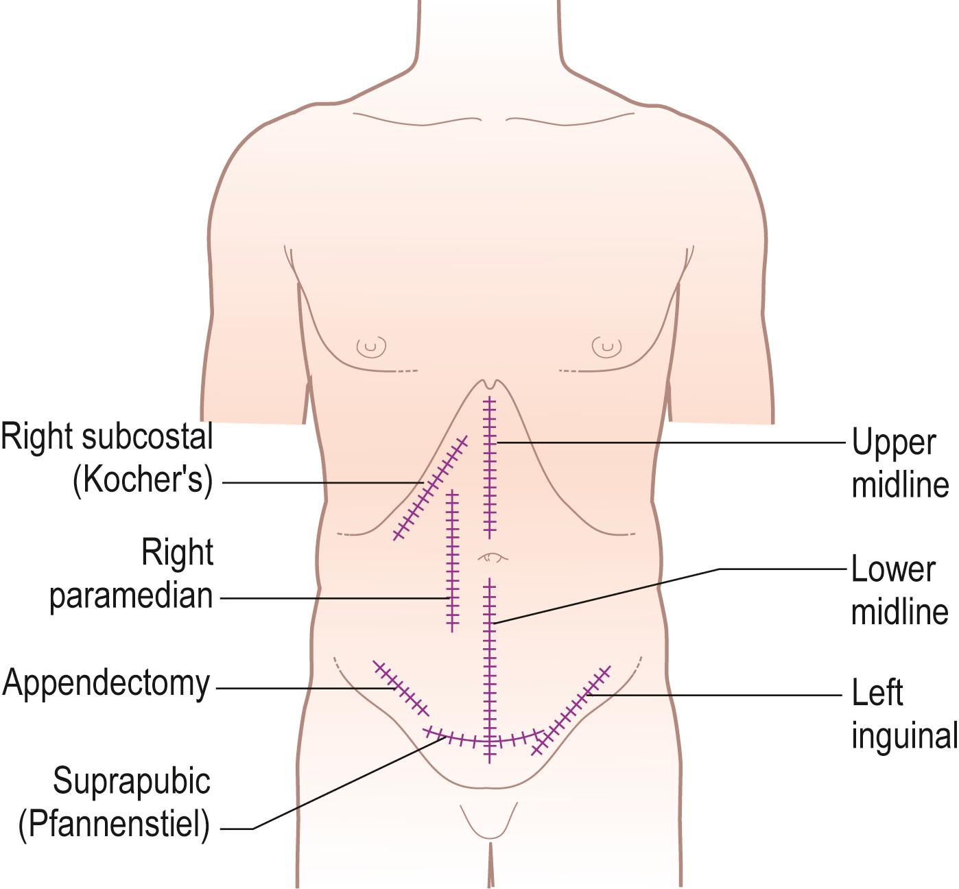 Figure 14. 8, Some commonly used abdominal incisions. The midline and oblique incisions avoid damage to the innervation of the abdominal musculature and the later development of incisional hernia.