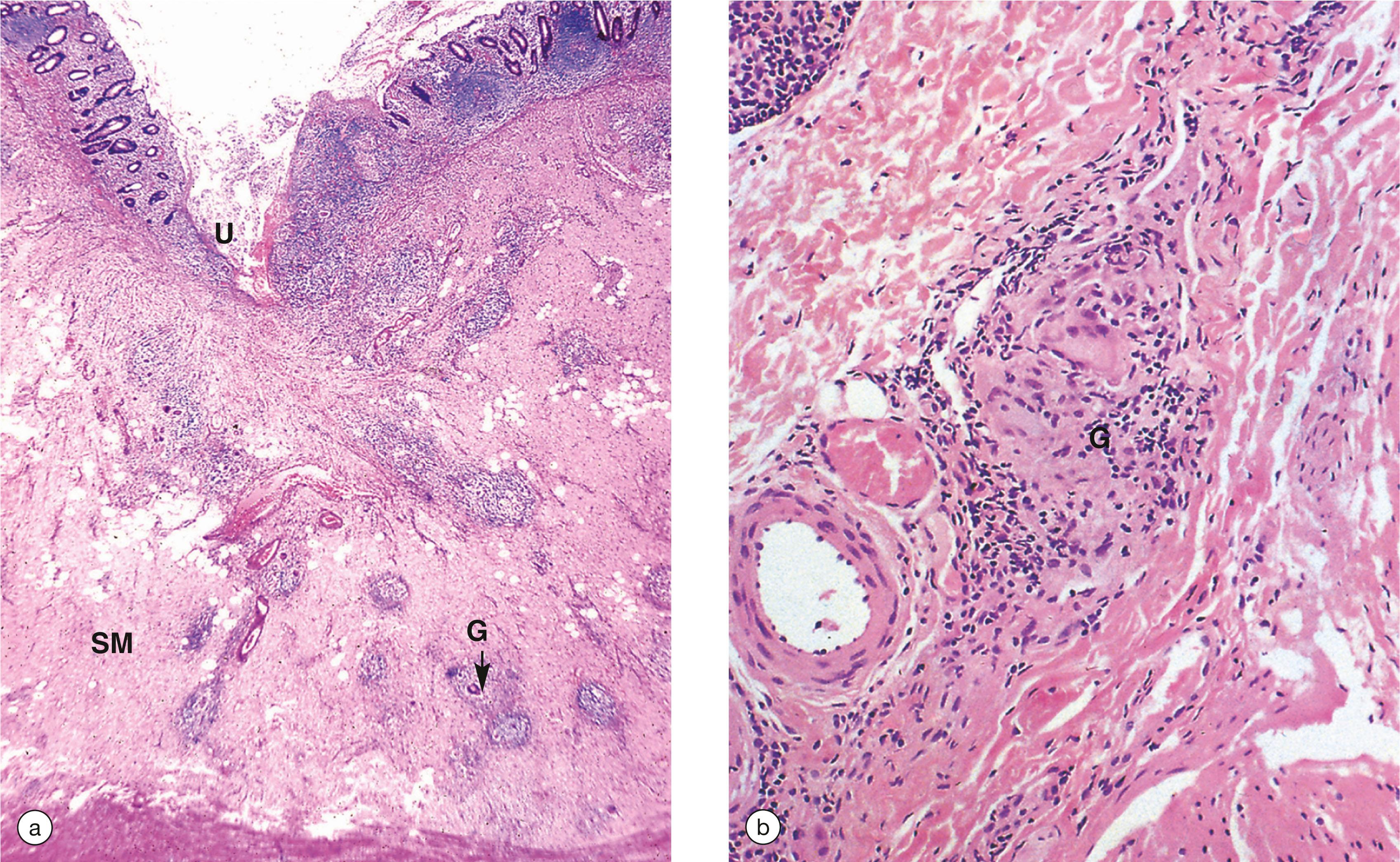 E-Fig. 14.11, Crohn’s disease