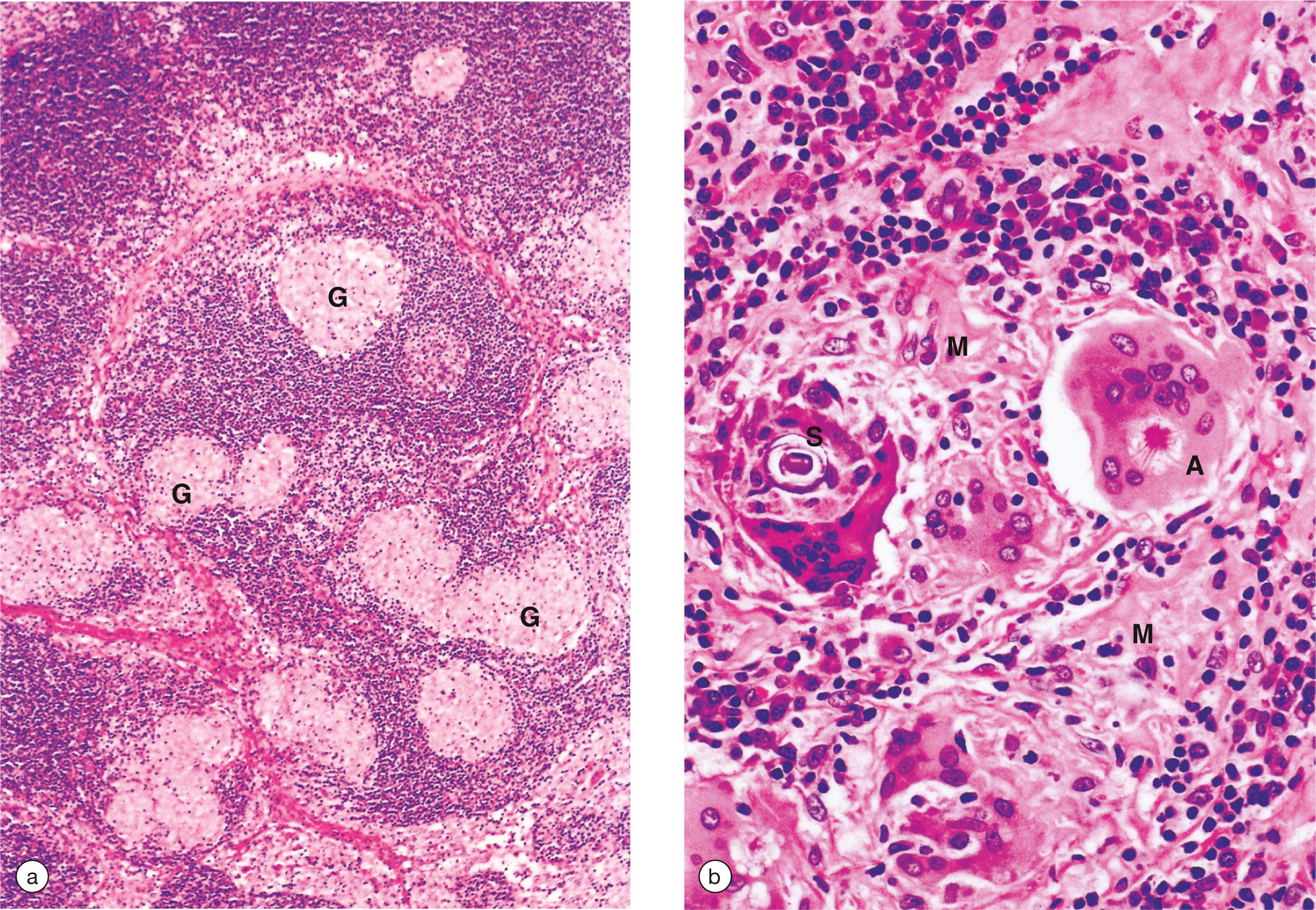 E-Fig. 14.12, Sarcoidosis