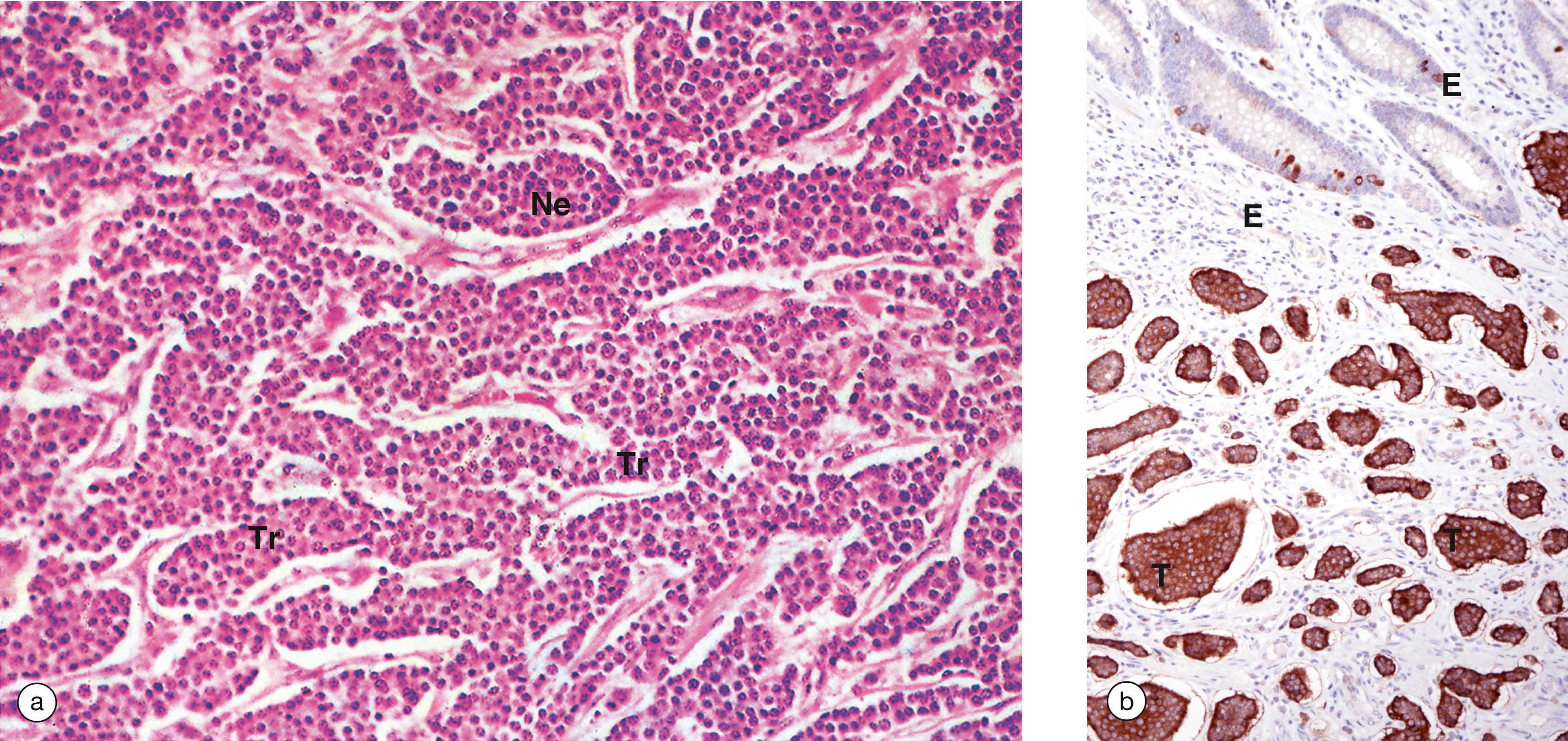 E-Fig. 14.9, Gastrointestinal well-differentiated neuroendocrine tumour