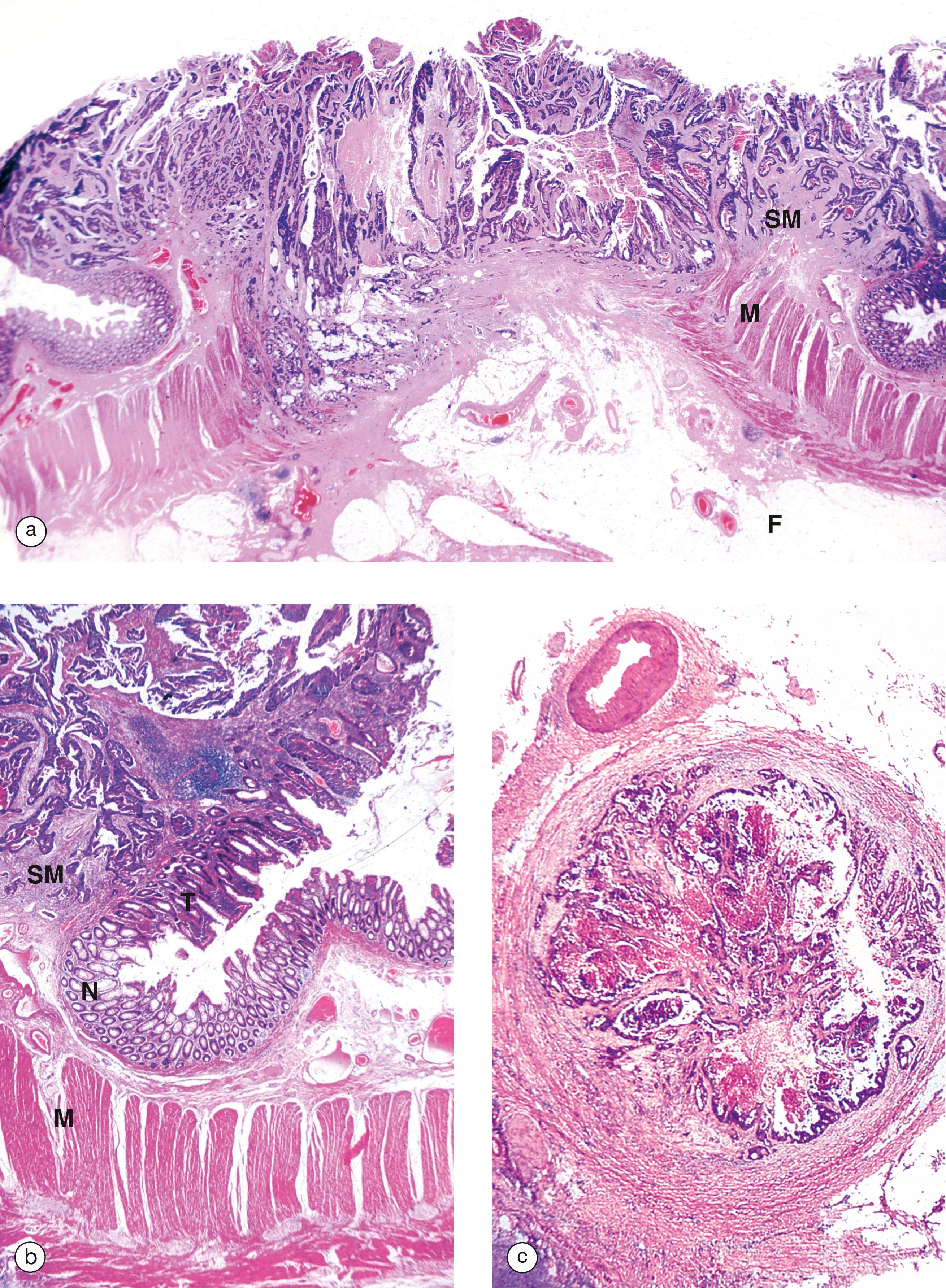 E-Fig. 14.6, Adenocarcinoma of the colon