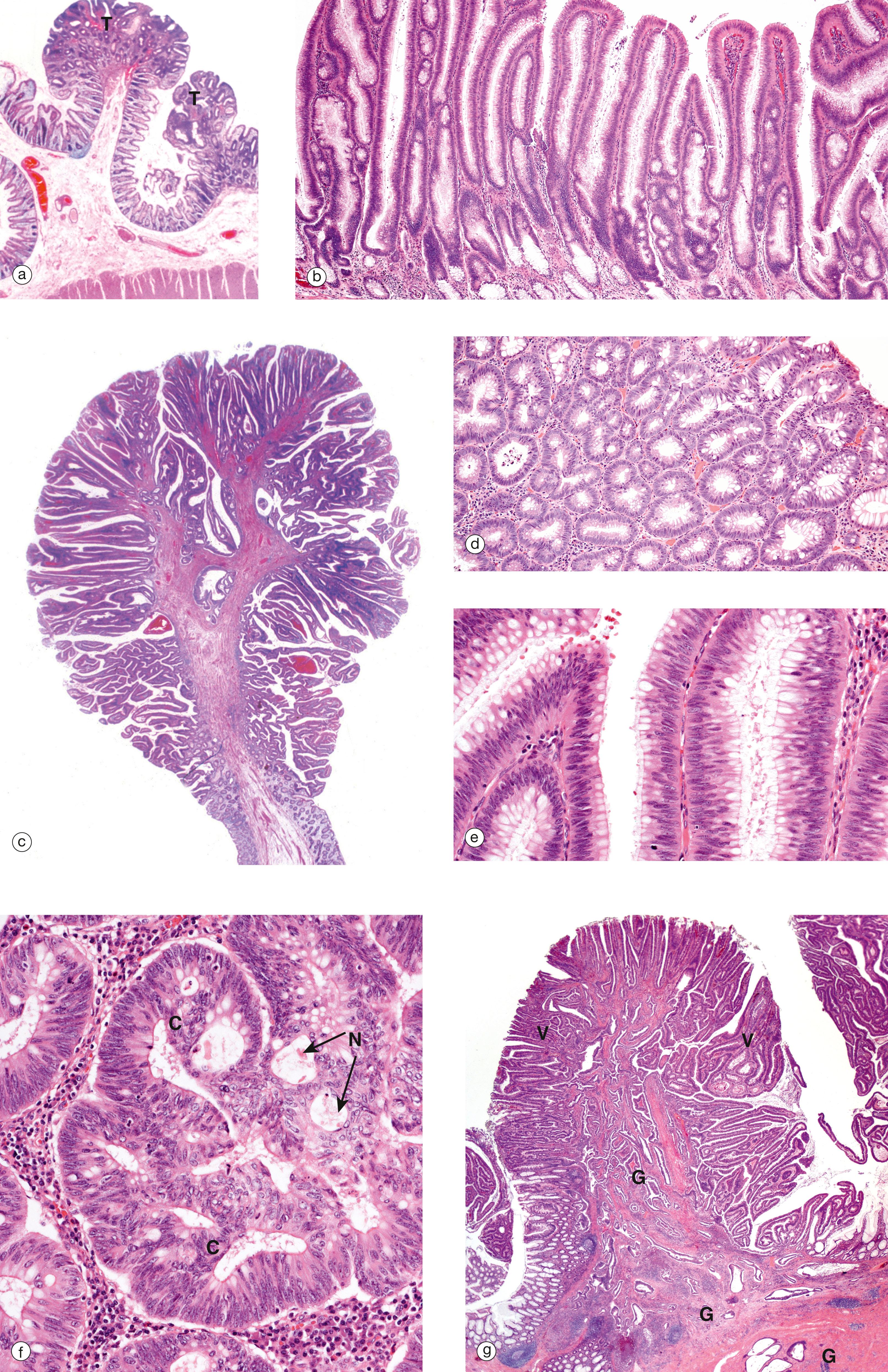 E-Fig. 14.7, Colonic adenomatous polyps