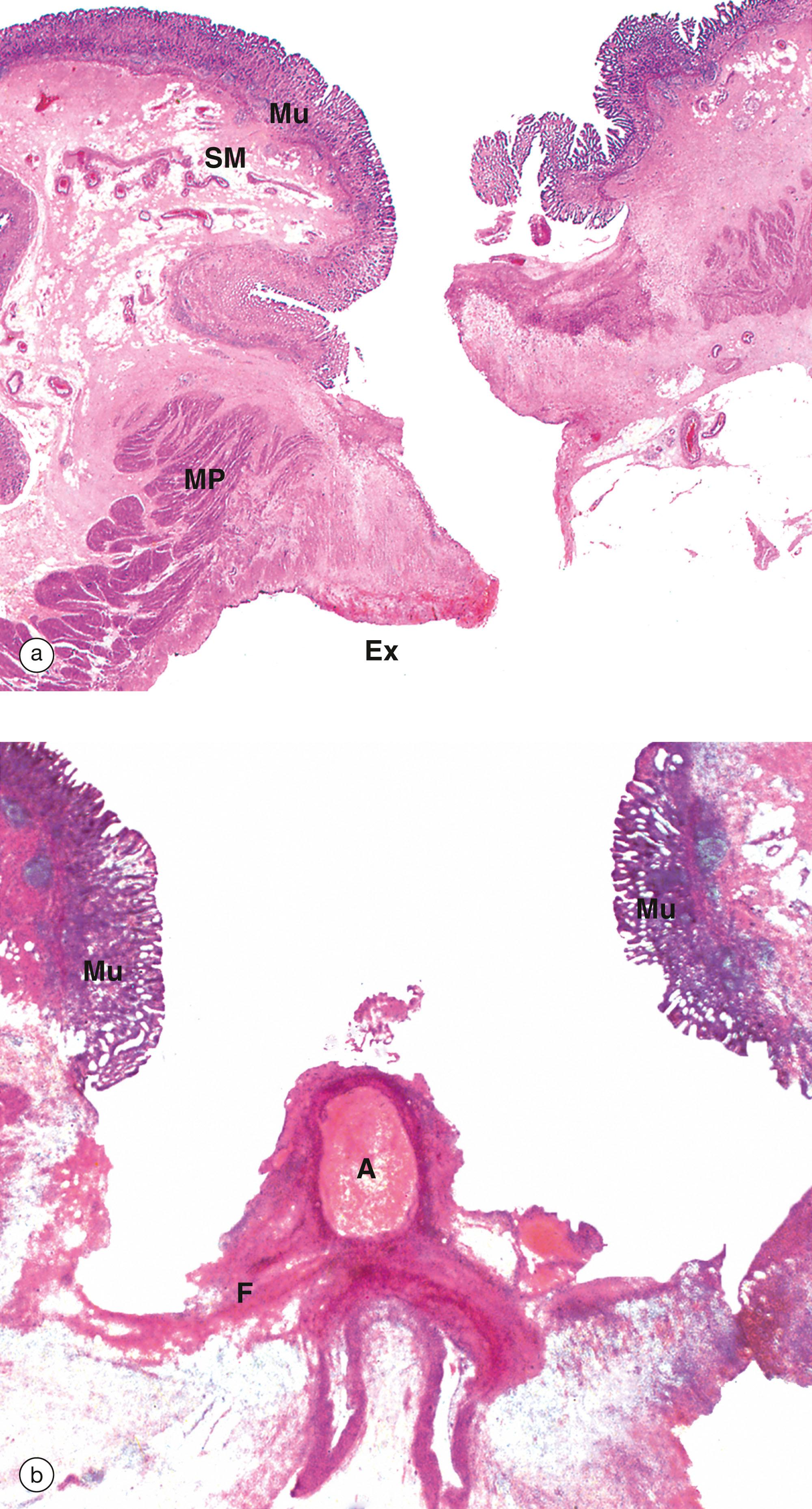 E-Fig. 14.3, Complications of peptic ulceration