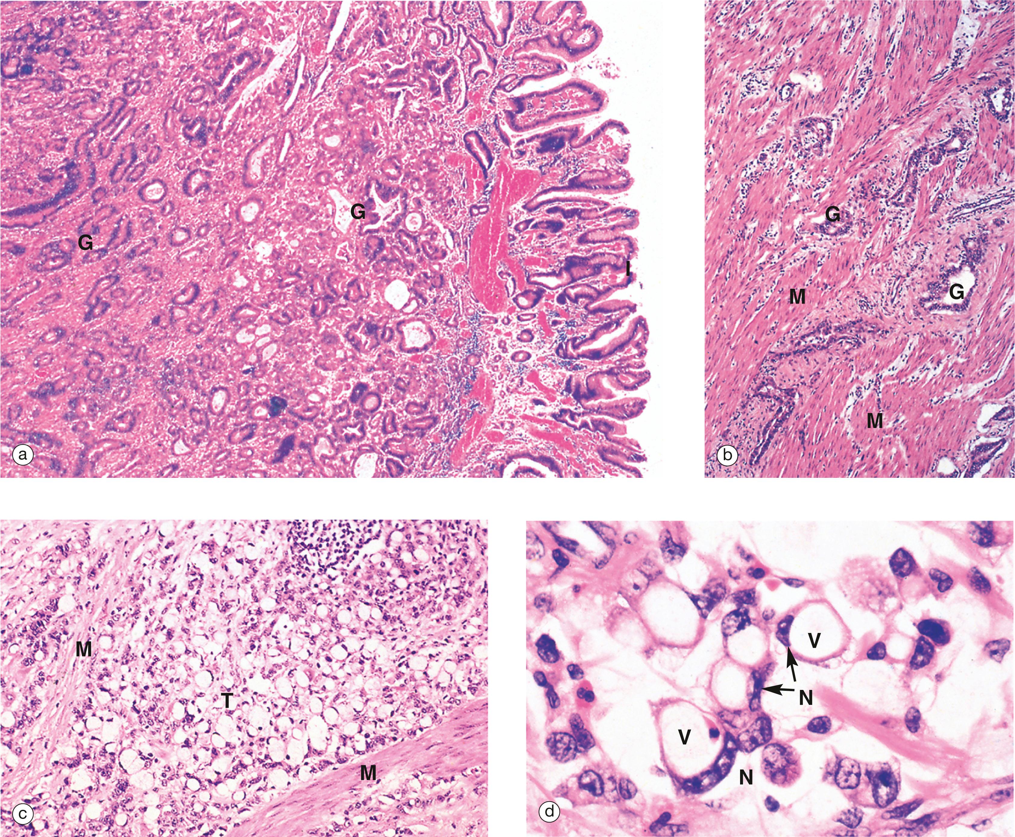 E-Fig. 14.4, Gastric carcinoma