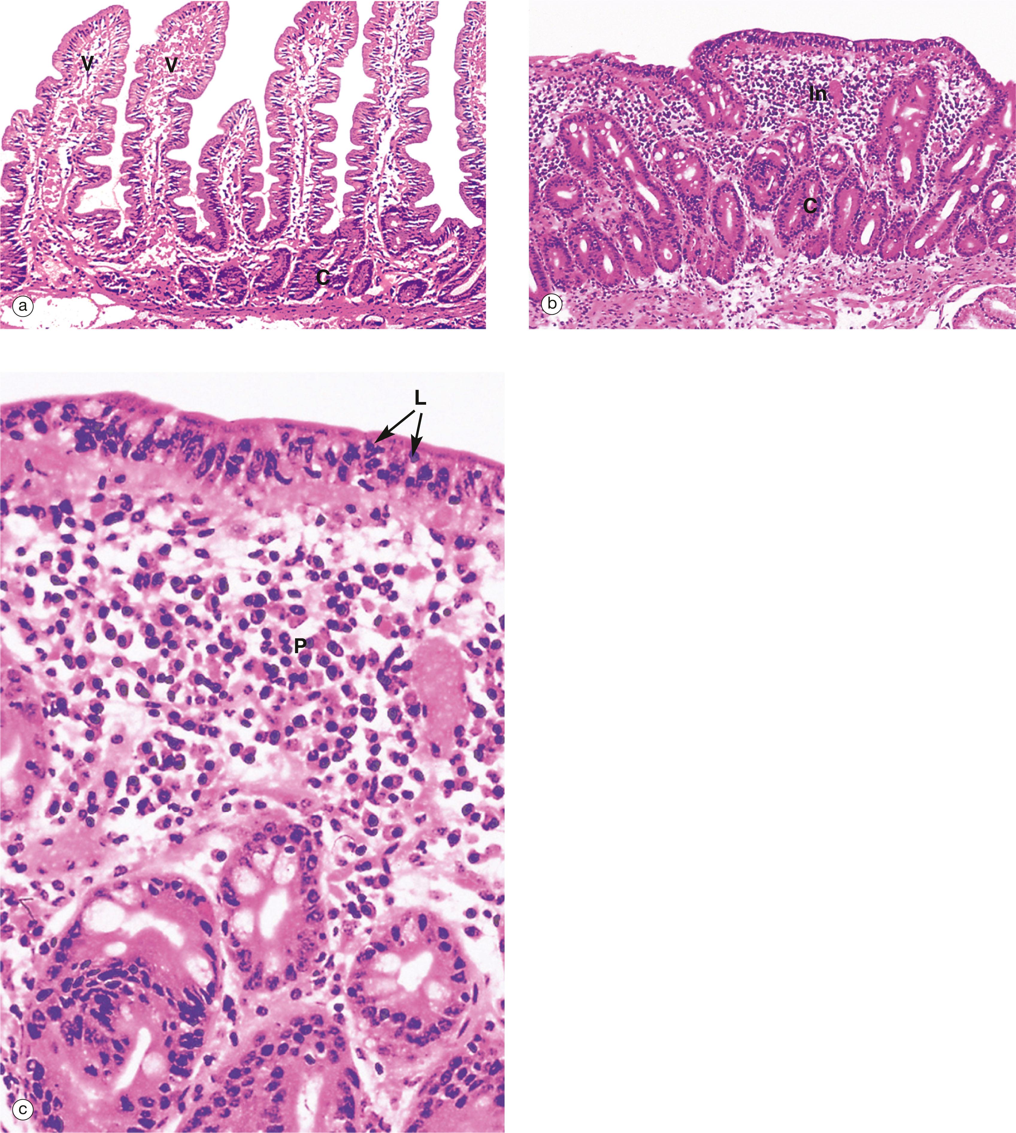 E-Fig. 14.5, Coeliac disease (gluten-sensitive enteropathy)