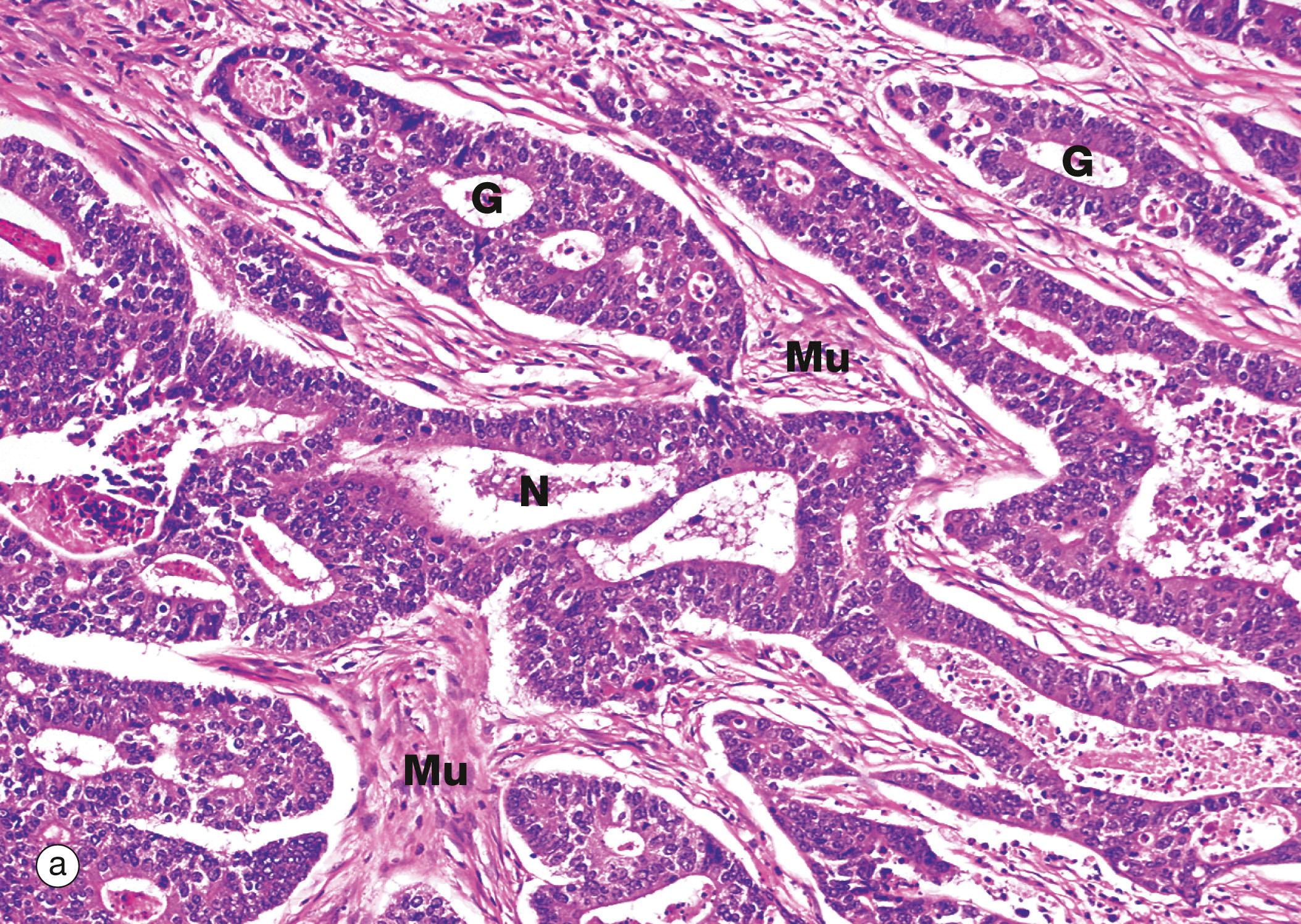 Fig. 14.30, The adenoma–carcinoma sequence