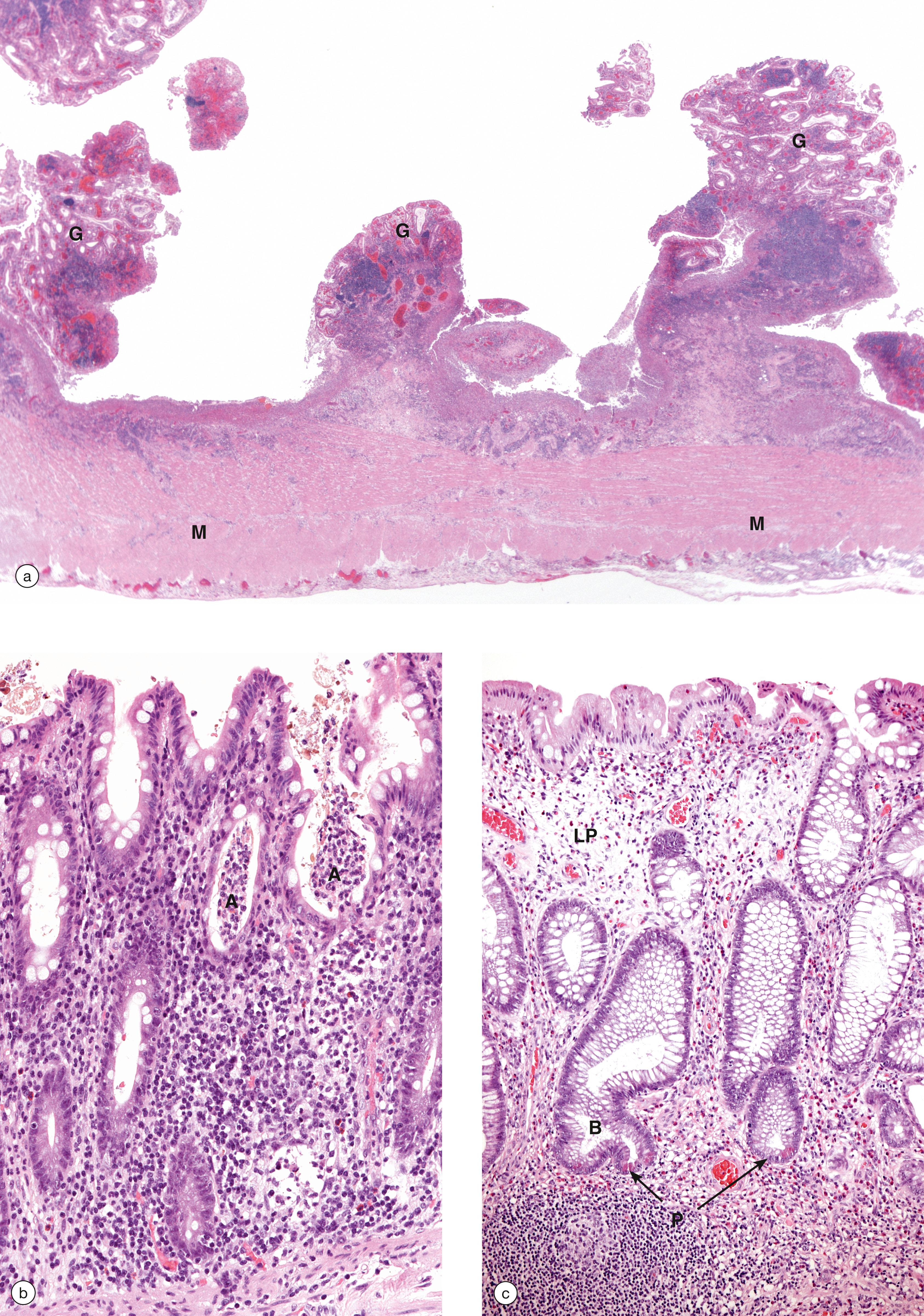 E-Fig. 14.10, Ulcerative colitis