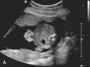 Fig. 20.1, (A) Gastroschisis at estimated gestational age of 20 weeks, 3 days. (B) Line drawing denoting size and location of gastroschisis defect.